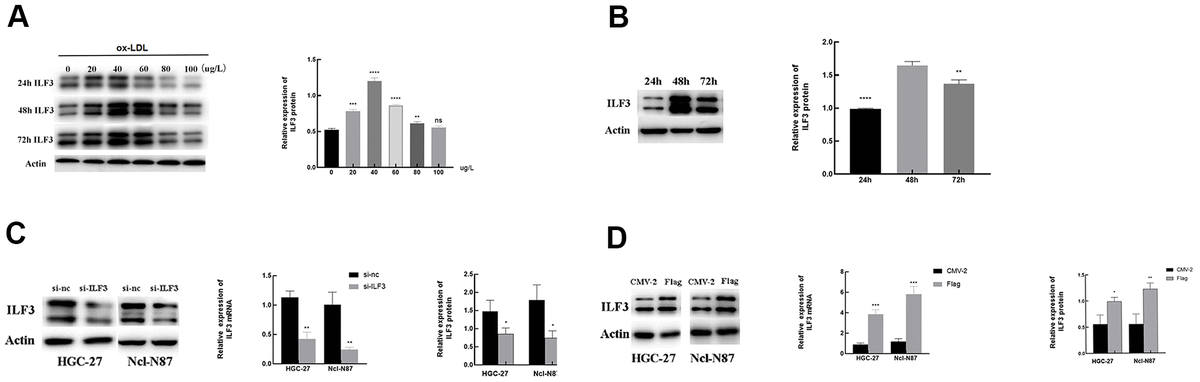 Ox LDL Mediated ILF3 Overexpression In Gastric Cancer Progression By