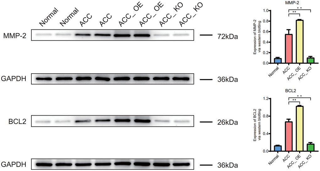 Western blotting. Expression of MMP-2, BCL2 proteins in ACC group.