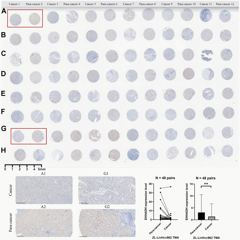 Immunohistochemical experiment and statistical analysis of the EHHADH gene based on HCC tissue microarray. (A–H) merely represent the rows of liver cancer tissue chips, without any special significance that needs to be reflected in the paper.