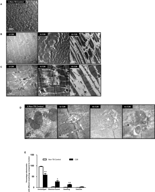Ultrastructural changes in GAS(A) Representative electron micrograph of muscle from non-tumor-bearing (non-TB) control mice. Magnification: × 8000. (B) Representative electron micrographs of muscle from C26-bearing mice. Magnification: × 8000 (i & ii), × 10000 (iii). (C) A higher magnification of muscle from C26-bearing mice. Vesicle-like structures (arrow); apparent tearing of myofiber (asterisk). Magnification: × 25000 (i & ii), × 30000 (iii). (D) Representative electron micrographs of muscle highlighting the morphologies of mitochondria. Electron-lucent areas (arrow); swelling (triangle); vesicle-like structures (asterisk). Magnification: × 40000 (i, ii & iv), × 30000 (iii). (E) Percentage of mitochondria with different morphologies in C26-bearing and non-TB mice. Data are presented as arithmetic means ± SEM. *p 