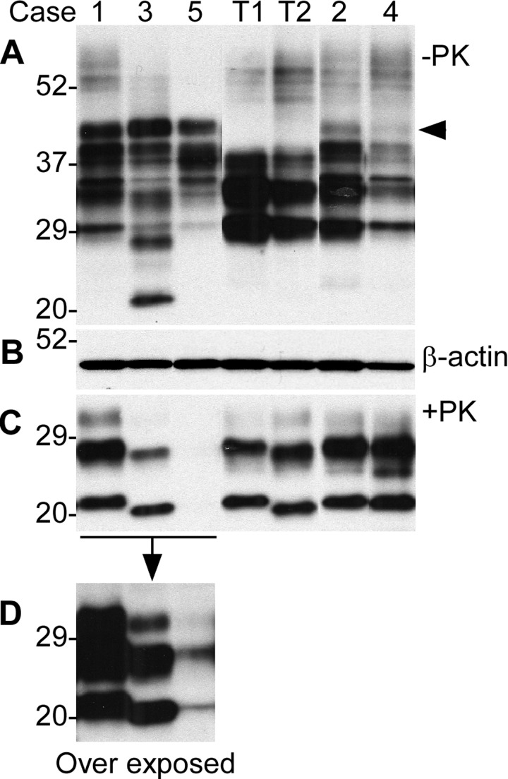 Detection of PrP in brains from five cases with six extra octapeptide repeats using Western blotting with 3F4. (A) Brain samples were from five cases (1 through 5) and were not treated with PK. T1: PrPSc type 1 control; T2: PrPSc type 2 control. (B) Western blot of β-actin, which was used to monitor the amounts of samples from each case. (C) The samples were treated with PK prior to SDS-PAGE and immunoblotting. The gel mobility of the PK-resistant PrP from the cases 1, 2, and 4 was similar to that of PrPSc type 1 control migrating at ~21 kDa while the case 3 was similar to PrPSc type 2 migrating at ~19 kDa. No PK-resistant PrP was visible in the case 5. (D) An over exposed smaller blot from the left part of the blot shown in C. The PK-resistant PrP bands from case 5 became detectable, the gel mobility of which was similar to that of case 2 migrating at ~19 kDa.