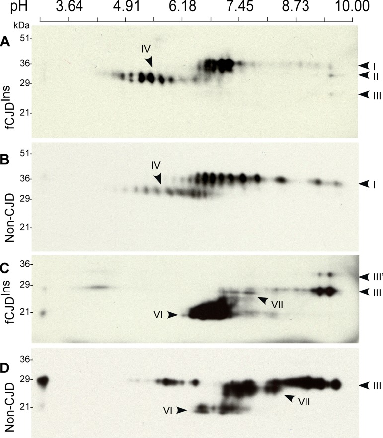 Two-dimensional Western blotting of PrP. (A) Comparison of untreated PrP from case 6 with fCJDIns+sPrPSc and non-CJD and sCJD. PrP from fCJDIns includes 2D spots I-IV and PrP from non-CJD mainly consists of 2D spots I and IV. (B) Comparison of PNGase F-treated PrP from fCJDIns and non-CJD. PrP from the two conditions comprises both full-length PrP (2D spots III) and N-terminally truncated PrP (2D spots VI); however, PrP from fCJDIns contains additional set of PrP spots (2D spots III’). The blots were probed with 3F4.