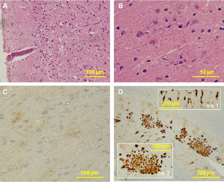 Histological and immunohistochemical examinations of brain tissues. (A) The cortex reveals no typical spongiform degeneration. (B) Several multicore plaques are present in the molecular layer of the cerebellum with a focal distribution. No pathology was seen in the pons and medulla. C: PrP immunostaining demonstrates weak staining with a synaptic pattern and occasional loose fine granular aggregates in the cerebral cortex. D: The molecular layer of the cerebellum shows a remarkable combination of strip-like staining (Ins. 1) and multicore plaques (Ins. 2). No immunostaining was seen in the pons and medulla.