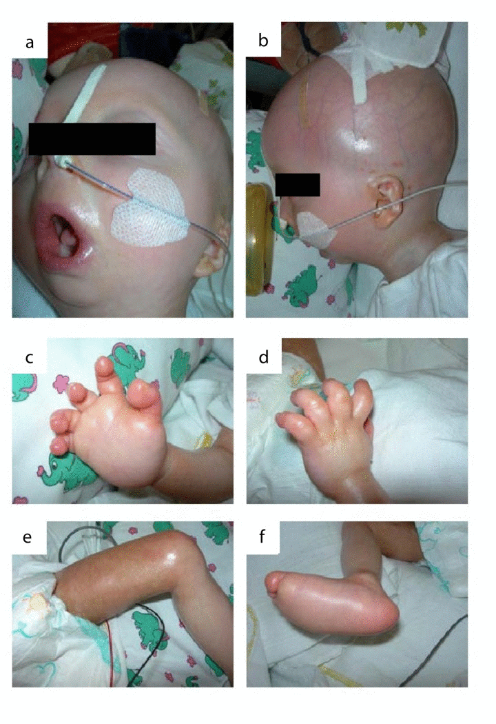 The patient at the age of 11 months: (a) microstomia, fixed in an o-shaped position (b) prominent superficial scalp veins, dysplastic auricels, microretrognathia. (c-e) acrocontractures. (f)„rocker bottom“ foot with prominent calcaneus and rounded bottom.