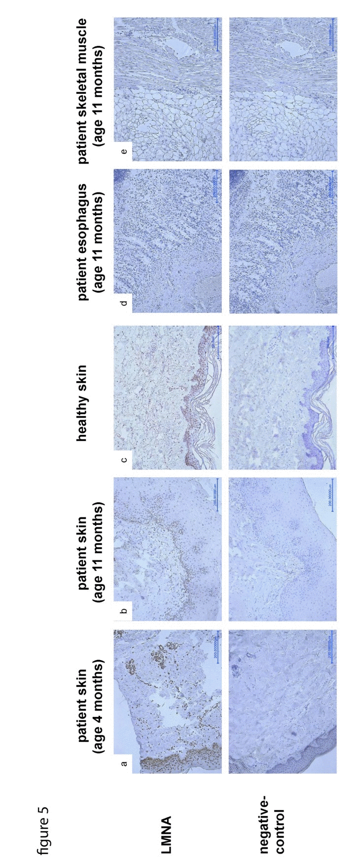 LMNA-staining of skin samples taken at age of 4 (a) and 11 (b) months respectively, shows decreasing amount and signal intensity of LNMA-positive nuclei in the dermo-epidermal junction zone compared to control skin (c). As a secondary finding, the rete ridges are progressively flattened, the skin appendages are poorly developed. LMNA-staining of samples taken from esophagus (d) and skeletal muscle (e) during autopsy does not detect any LMNA signal.