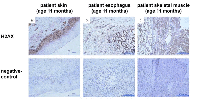 Staining with anti-gamma H2AX (phospho S139) antibody of samples taken from skin (a), esophagus (b) and skeletal muscle (c) during autopsy at age of 11 months shows a strong signal, indicating presence of DNA double strand breaks.