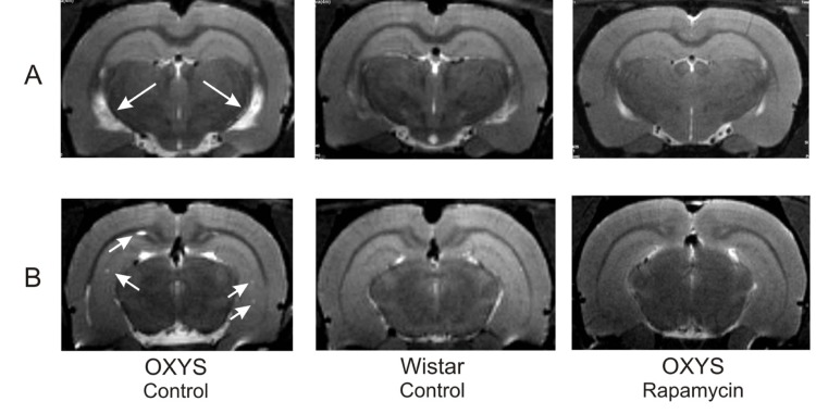 MRI image of brain 4 month-old OXYS, Wistar rats and OXYS rats after rapamycin supplementation. (A) Hydrocephaly of lateral ventricle of OXYS rats (arrow). (B) Loci of demyelinization of the brain OXYS rats (arrow).