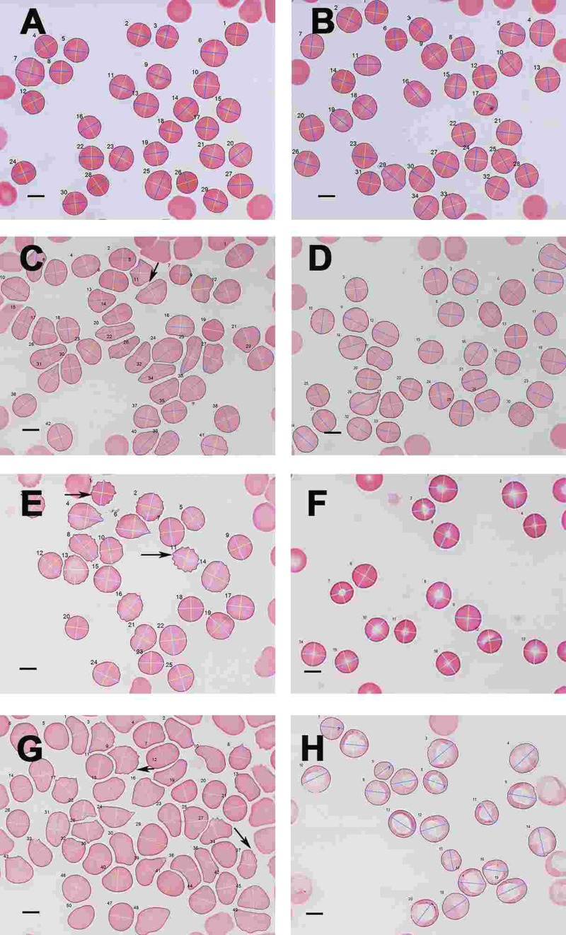 Light microscopy micrograph of whole blood smears from (A) a healthy individual (serum ferritin: 13 ng.mL-1) and (B) a healthy individual, (serum ferritin: 48 ng.mL−1) (C) a female PD individual (serum ferritin: 152 ng.mL−1) and (D) the same PD individual after treatment with desferal; (E) a male PD individual (serum ferritin: 21 ng.mL−1) and (F) the same PD individual after treatment with desferal; (G) a female PD individual (serum ferritin: 568 ng.mL−1) and (H) the same PD individual after treatment with desferal. Major and minor axes indicated on the RBCs, as determined by the C# program written for the analysis. Scale bar = 5 μm.
