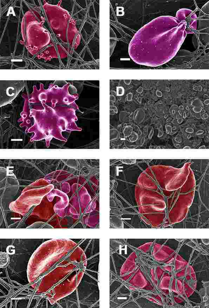 Erythrocytes of Parkinson's disease patients prepared from whole blood with added thrombin. Serum ferritin levels: (A) 118 ng.mL−1 (B) 194 ng.mL-1 (C) 21 ng.mL-1 (D) 107 ng.mL−1 (lower machine magnification to show general SEM view of erythrocytes) (E) 145 ng.mL−1 (F) 358 ng.mL-1 (G) 372 ng.mL-1 (H) 90 ng.mL-1 Scale bar = 1μm.