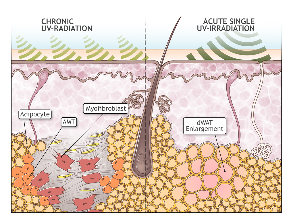 Possible role of adipocyte-myofibroblast transition in extrinsic aging. Absorption of UV radiation in the skin causes acute enlargement of the dWAT layer. However, upon chronic overexposure to UV radiation, it causes the depletion of dWAT and a concurrent development of cutaneous fibrosis, presumably through adipocyte-myofibroblast transition (AMT). Replacement of dWAT volume with fibrosis leads to production of mechanically heterogeneous skin structures and to the loss of the effective skin volume.