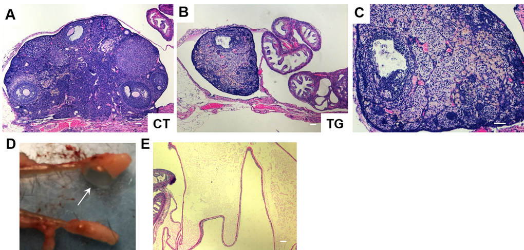 H&E staining of ovarian sections from 40-week-old (A) control (CT) and (B) COX2 transgenic mice (magnification x5). (C) Higher magnification (x10) view of the ovary shown in (B). (D) The ovary from 22-week-old COX2 transgenic mouse showing a cystic structure filled with a clear fluid (arrow). (E) H&E stained bursal cyst in COX2 transgenic mouse. The cyst contains pale eosinophilic proteinaceous material. Scale bar=100 μm