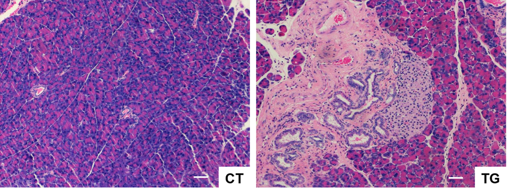 H&E stained sections of pancreas from COX2 transgenic mice (TG) showing the loss of the pancreatic acini, the increase of the metaplastic pancreatic ducts with dysplastic changes, peri-ductal fibrosis, and mononuclear inflammatory cell infiltration in the highly vascularized fibrotic stroma. Hyperplasia of the Langerhans islets was also noticed. Scale bar=100 μm