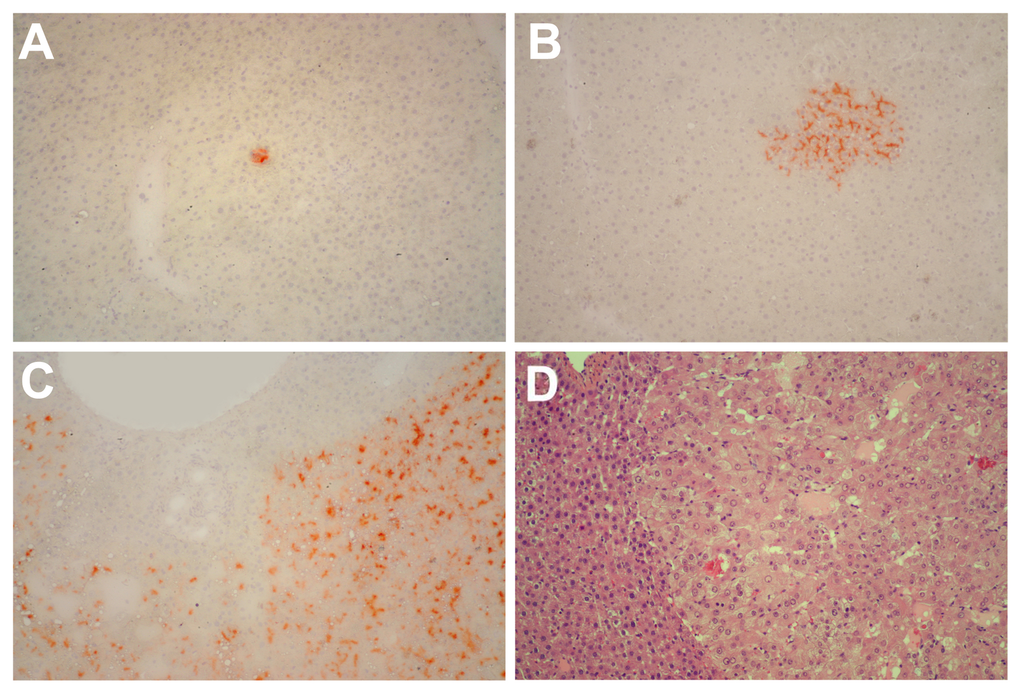 Panels (A) and (B) Histochemical staining for DPPIV of liver samples obtained from rats transplanted with pre-neoplastic hepatocytes at young age and killed 8 months after Tx. Small clusters of DPPIV-expressing hepatocytes (orange-rust) were discerned in all animals. Histochemical staining for DPPIV (panel C) and standard H&E staining (panel D) of a large hepatic nodule from a rat transplanted with pre-neoplastic hepatocytes at old age and killed 8 months later. Note the typical appearance of nodular hepatocytes arranged in multiple cell-thick plates. Magnification: 100x.