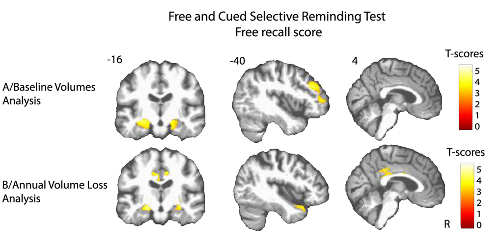 Cerebral substratum of episodic memory decline. (A) Transversal VBM analysis: grey matter volumes at baseline and memory decline. (B) Longitudinal VBM analysis: grey matter annual rates of atrophy and memory decline. Each model was adjusted for age, sex, level of education, APOE4 allele carrier status and total intracranial volume (except for longitudinal VBM analysis). Clusters presenting statistically significant associations (q