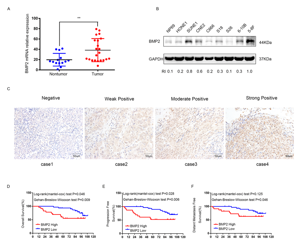 The expression of BMP2 is up-regulated in NPC and correlates with poor prognosis. (A) qRT-PCR analysis showed that the expression of BMP2 mRNA was significantly higher in NPC tumor tissues (n=22) than non-cancerous nasopharyngitis tissues (n=14) (** pB) The expression level of BMP2 in NPC cell lines (HONE1, SUNE1, CNE2, C666-1, S18, S26, 6-10B and 5-8F) and the normal epithelial NP69 was analyzed by Western blot. NP69 showed a relative low level of endogenous BMP2 protein expression and the protein expression level of BMP2 was obviously higher in S-18 and 5-8F cells with high tumorigenic and metastatic potential compared with their paired subclones S-26 and 6-10B cells with low tumorigenic and metastatic potential. (C) BMP2 immunostaining of representative images of NPC patients with different IHC scores. (D, E, F). Patients with high expression of BMP2 had shorter overall survival (OS) (D), progression-free survival (PFS) (E), and distant-metastasis-free survival (DMFS) (F) than those with low levels of BMP2.