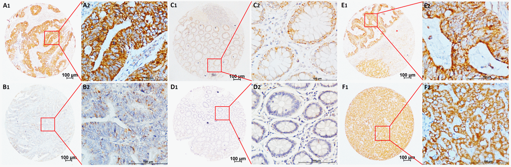 Representative TMA-IHC staining of CNPY2 isoform2 protein. (A1, A2) Colon adenocarcinoma with high CNPY2 isoform2 expression in the cytoplasm of CRC cells and some expression in the extracellular matrix; (B1, B2) Colon adenocarcinoma with low CNPY2 isoform2 staining in the cytoplasm of CRC cells; (C1, C2) Tumor-adjacent normal tissues with positive staining of CNPY2 isoform2; (D1, D2) Tumor-adjacent normal tissues with negative staining of CNPY2 isoform2. (E1, E2) High CNPY2 isoform2 expression in liver metastatic tumor tissues; (F1, F2) High CNPY2 isoform2 expression in normal liver tissues. Original magnification was 40×with 100 μm scale per in A1, B1, C1, D1, E1, and F1; 400× with 100 μm scale per bar in A2, B2, C2, D2, E2, and F2.