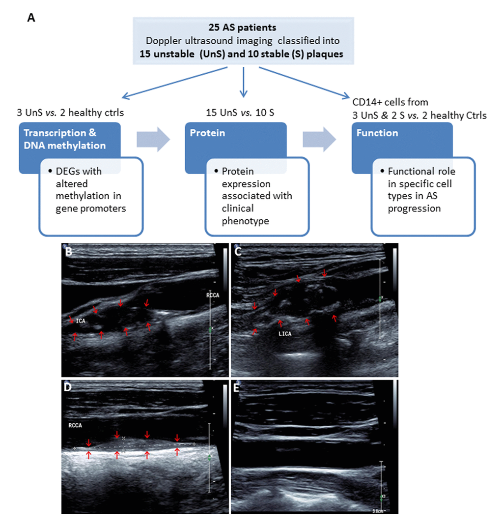 (A) Work flow of the present study. A total of 25 consecutive patients undergoing carotid endarterectomy for AS, and 2 healthy subjects were enrolled. All patients underwent Doppler ultrasound imaging for the carotid plaques before endarterectomy, and the carotid atherosclerotic plaques were classified as complex lesion or “unstable” (UnS) and noncomplex or “stable” (S) plaques. Two UnS plaque samples were used for RNA-seq (one patient and one age-/gender matched healthy control), 5 for DNA methylation (2 patients and 2 healthy controls, including the same samples for RNA-seq, and bilateral carotid plaques from one same patient), 25 for protein and histological analysis (15 UnS and 10 S plaques), and 5 fresh samples to isolate CD14+ myeloid cells (i.e. monocytes and macrophages) for functional studies, including siRNA transfection and cytokines analysis for macrophages, and proliferation and cell cycle analysis for vascular smooth muscle cells (VSMCs). (B-E) Representative Doppler ultrasound images showing UnS (B, C) and S (D) carotid artery plaques, and a normal carotid artery (E). Plaques are demonstrated by red arrows.