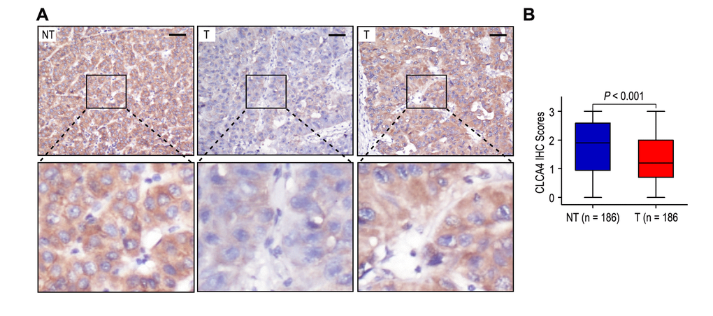 The expression of CLCA4 was downregulated in hepatocellular carcinoma tissues. (A) Immunohistochemistry assays of CLCA4 expression in HCC samples and adjacent non-tumorous tissues. The upper left panel represents high CLCA4 expression in adjacent non-tumorous tissues. The upper middle and right panel represents low and high CLCA4 expression in HCC tissues. Lower panels represent magnified pictures of boxed area in the corresponding upper panels. The line scale bar represents 50 μm. (B) CLCA4 expression in HCC tissues was compared with that in adjacent non-tumorous samples. Statistical analysis was performed by Paired-Samples t-test.