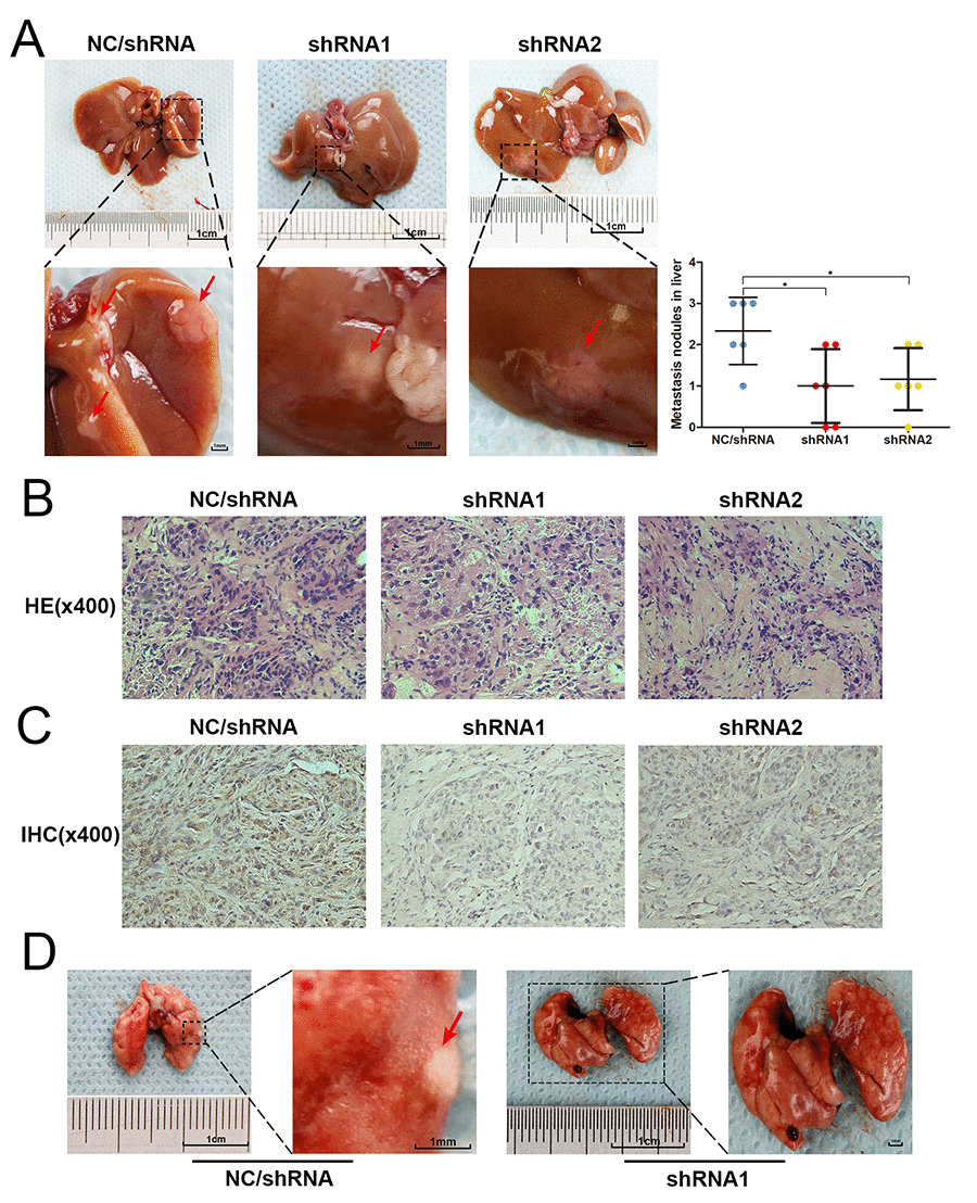 USP4 knockdown blocked the metastasis of HCC cell in vivo. (A) Representative images of hepatic metastatic nodules originated from SK-Hep1-shRNA/USP4 cells and negative control cells, and the quantitative analysis of hepatic metastatic nodules from each group (* P B) The hematoxylin and eosin (HE) staining evaluated the pathological character of hepatic metastatic nodules originated from SK-Hep1-shRNA/USP4 cells and negative control cells (magnification ×400). (C) Immunohistochemical staining (IHC) examined the expression of USP4 in hepatic metastatic nodules originated from SK-Hep1-shRNA/USP4 cells and negative control cells (magnification ×400). (D) Representative images of metastatic nodules in lung originated from negative control cells.