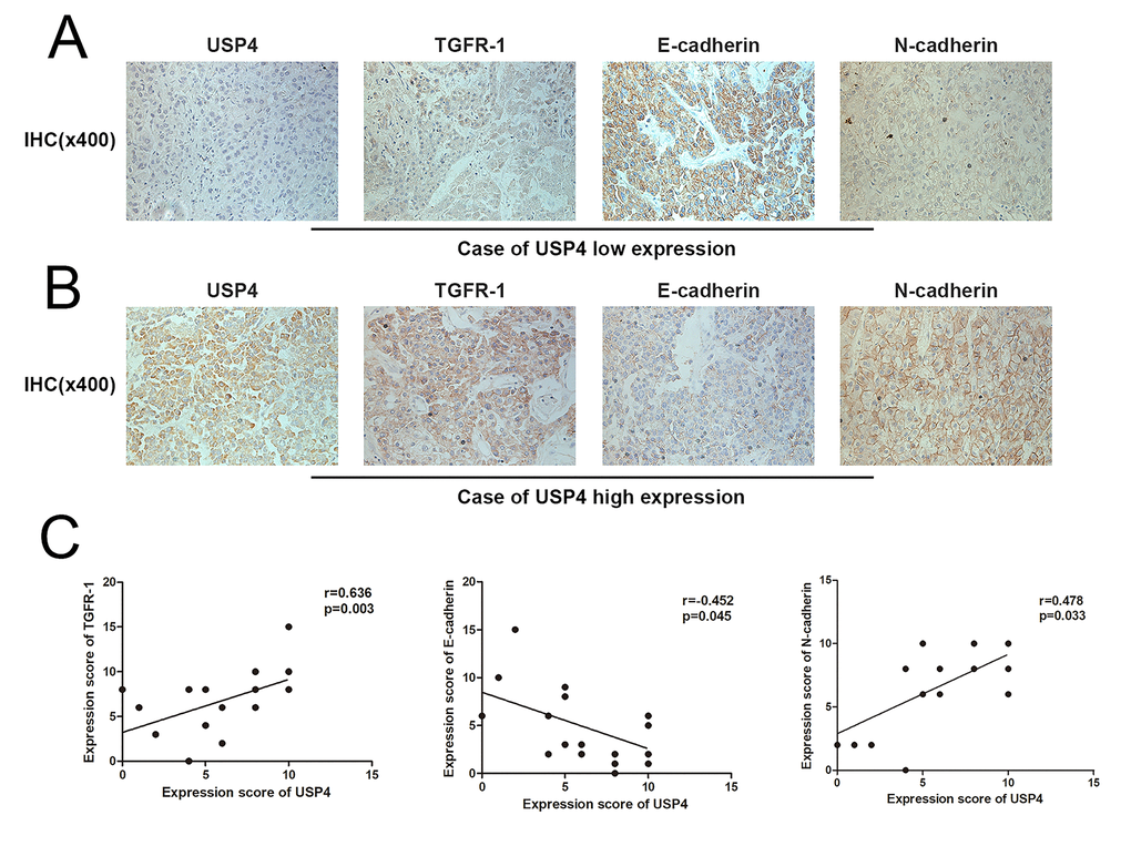 USP4 expression was positively correlated with EMT process in HCC tumor tissues. (A) Immunohistochemical staining (IHC) detected the expression of USP4, TGFR-1, E-cadherin, N-cadherin in USP4 low expression cases (magnification, ×400). (B) Immunohistochemical staining (IHC) detected the expression of USP4, TGFR-1, E-cadherin, N-cadherin in USP4 high expression cases (magnification, ×400). (C) The correlation between USP4 expression and TGFR-1, E-cadherin, N-cadherin was analyzed by Spearman rank correlation. r>0 and p 