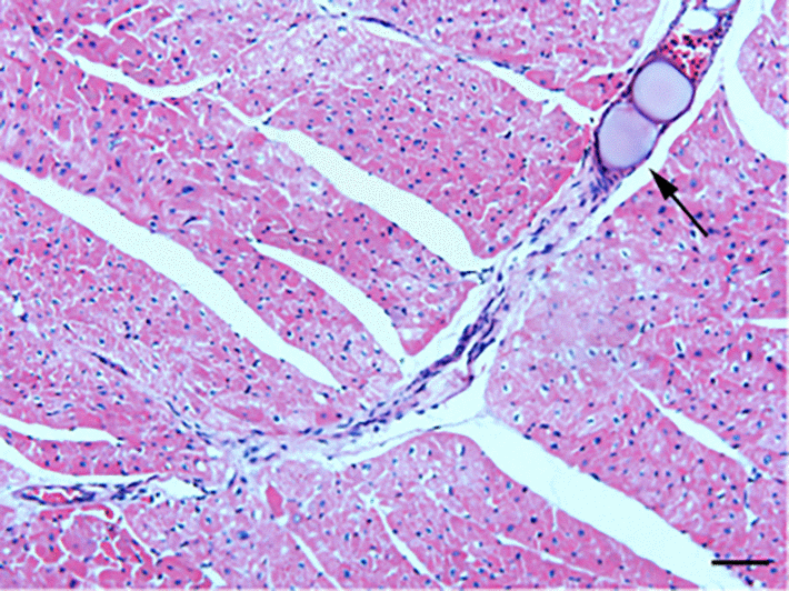 HE staining of microinfarct areas after CME modeling. Myocardial tissue exhibited edema and degeneration around the microspheres, accompanied by a large number of infiltrating inflammatory cells. The arrow indicates microspheres in an arteriole (x200, scale bar = 50 μm).