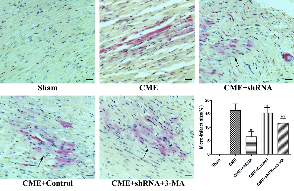 Inhibition of Egr-1 reduced myocardial microinfarct areas following CME. HBFP staining stained the normal myocardium yellow, while the ischemic myocardium was stained red. The arrow indicates the microinfarct focus (x400, scale bar = 25 μm). The results are presented as the means ± SD from at least three independent experiments. *P #P 