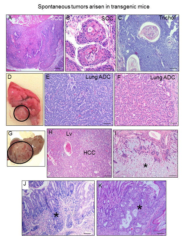 K5-CYLDC/S mice develop spontaneous tumors in many organs. (A-C) Skin tumors. Infiltrating SCC arisen in the back skin of 8-month-old transgenic mouse (A, B). (C) Hair follicle derived tumor (trichofolliculoma) developed in the snout of a K5-CYLDC/S mouse. (D) Macroscopic appearance of a lung adenocarcinoma. (E) Lung acinar adenocarcinoma. (F) Lung papillary adenocarcinoma. (G, H) Hepatocellular carcinoma (HCC); liver (Lv). (I) Mammary adenoepithelioma (asterisk). (J) Well differentiated gastric adenocarcinoma (asterisk). (K) In situ gastric carcinoma (asterisk). Scale bars: 500 μm (A); 300 μm (C, J, K); 200 μm (E, F); 250 μm (H, J); 100 μm (B).