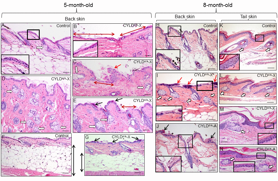 Histopathological signs of premature aging in the back skin of young (5- and 8-month-old) transgenic mice. Representative histology of the back skin of 5-month-old Control and transgenic mice (A-G). (A) Histology of the back skin of a Control mouse. Observe the presence of small sebaceous glands (white arrow) and 3 layers of keratinocytes in the interfollicular epidermis (higher magnification is showed in the inset). (B-E) The epidermis of the K5-CYLDC/S mice shows frequent and extensive areas of atrophy (double-headed red arrows in B and C; also compare the inset in B with that of A); as well as papillomatous hyperplasia (red arrow in C) and epidermal ridges (black arrows in E and G). Abundant hyperplastic sebaceous glands -often orphan, were detected (white arrows in C-E). (F-G) Observe the scarce adipose tissue present in the skin of the transgenic mice (compare the length of the double-headed black arrows). Representative histology of the back skin of Control (H) and transgenic mice (I, J) of 8-month-old. Observe in the K5-CYLDC/S mice the presence of papillomatous hyperplasia (red arrows in I); epidermal ridges (black arrows in J); abundant hyperplastic sebaceous glands (white arrows), some of them orphan (without HF) (I), and patchy epidermal atrophy associated to moderate hyperkeratosis (compare the inset in H with those of I and J). Representative histological images of the tail skin of Control (K) and transgenic mice (L-N). Note in the skin of transgenic mice the presence of hyperplastic sebaceous glands, most of them orphan (white arrows), and epidermal atrophy (compare the insets in K with those of M and N). Images of the histology of both K5-CYLDC/S-X and K5-CYLDC/S-A are shown. White arrows, sebaceous glands; black arrows: epidermal ridges; double-headed red arrows: areas of epidermal atrophy. Scale bars: 150 μm (C, E); 180 μm (A, B, D, I, J, L-N); 200 μm (H, K) and (F, G) 350 μm.