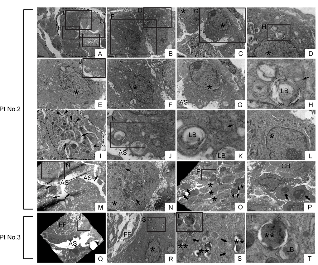 Dysmorphic lamellar bodies, cytoplasmic vacuolation, and euchromatic nucleus are widely shared in metaplastic bronchiolar epithelial cells in IPF lung. Transmission electron microscopy was performed on lung samples from patients with IPF (n=5). Data presented are from Patient No. 2 and Patient No. 3. Labeled boxes correspond to their respective enlarged images. (A & I) A small bronchiole (circled by dashed line in Panel A) is occluded by a suspected cell structure featuring multiple granules, lamellar bodies (arrowheads in Panel I), and an enlarged endoplasmic reticulum (arrows in Panel I). (B-G & L) Bronchiolar epithelial cells exhibit morphological variation with frequently encountered features of euchromatic nucleus (asterisks in Panel C, D, E, F & G) and dysmorphic lamellar bodies. (H) A dysmorphic lamellar body next to a trace of mitochondria. (J & K) Lamellar bodies present at the apical surface of a bronchiolar epithelial cell are about to secrete their contents into the airspace. An arrow in Panel K denotes mitochondria. (M) A narrowed bronchiolar lumen lined by highly vacuolated epithelial cells with dysmorphic lamellar structures (arrows). (N) A cell with euchromatic nucleus (asterisk) and morphological feature of club cell (numerous secretory granules in cytoplasm) is located in bronchiolar epithelium. Prominent phagosomes are noted in cytoplasm (arrows). (O & P) Hyperplastic bronchiolar epithelium with collagen deposition in the interstitium. Cells with euchromatic nucleus (asterisks in Panel O) are located across apoptotic cells (arrows in Panel P) from collagen bundle bundles (CB). Cells with numerous secretory granules in cytoplasm, which are considered to be club cells, are noted (arrowhead in Panel O). Seen at luminal side are cells with numerous lamellar structures in cytoplasm (arrows in Panel O). (Q-T) Metaplastic epithelial cell on fibroblastic foci features dysmorphic mitochondria (arrows in Panel S), numerous phagosomes (double asterisks in Panel S & T), and a small number of lamellar bodies. AS: Airspace; FF: Fibroblastic foci; LB: Lamellar body. *(single asterisk) = Euchromatic nucleus, **(double asterisks) = Phagosome. Magnifications: (A) 3000X; (B, C, and R) 8000X; (D & L) 20000X; (E, F, G, I, N & P) 12000X; (H & K) 60000X; (J & S) 30000X; (M) 4000X; (O) 2500X; (Q) 1500X; (T) 80000X.