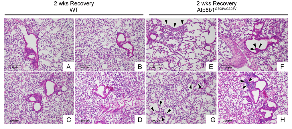 Atp8b1G308V/G308V mice exposed to hyperoxia and returned subsequently to normoxia for recovery develops late-onset interstitial fibrosis. Representative photomicrographs of H&E-stained lung sections from 7-9-wk-old WT (A-D) and Atp8b1G308V/G308V mice (E-H) that were exposed to 100% O2 for 48 hrs and allowed to recover under normoxia for 12 days (n=3 for each). WT mice show marked recovery with some hypercellularity remaining in bronchiolar regions. Atp8b1G308V/G308V lungs display juxtaposition of normal lung with collapsed alveoli beneath the pleura (arrows in Panel E), distinct hyperplastic epithelium (arrowheads in F), thick-walled cystic air space (arrowheads in Panel G), and hypercellularity in bronchovascular interstitium (arrowheads in Panel H). Magnifications: (A-H) 100X. Data presented are representative of two independent experiments.