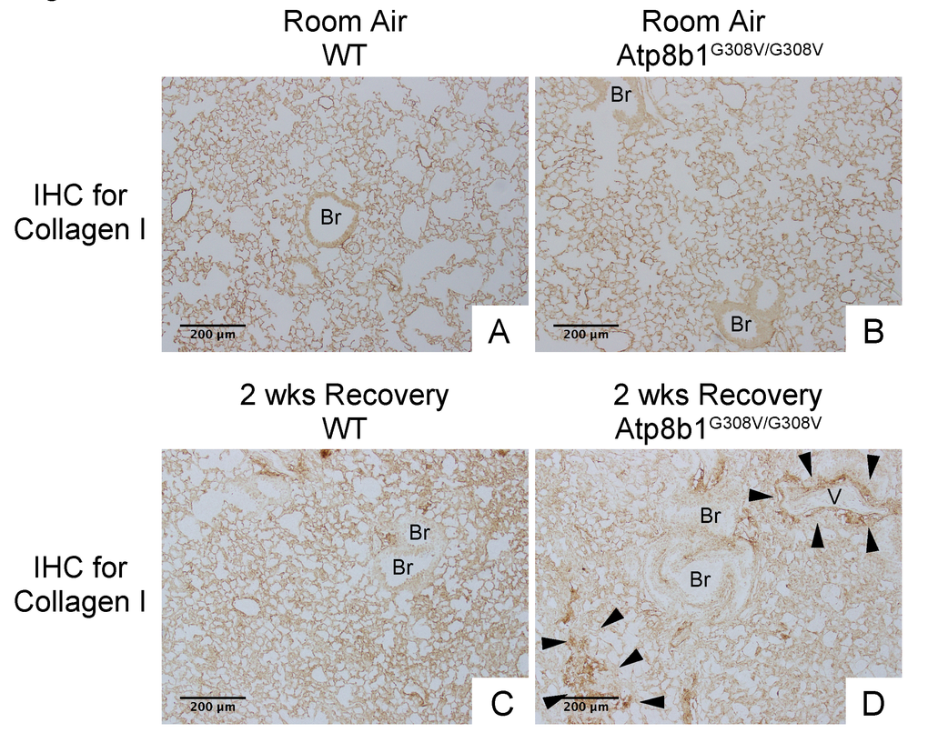 Atp8b1G308V/G308V mice exposed to hyperoxia and returned subsequently to normoxia for recovery display aberrant deposition of collagen in the lung. Photomicrographs of lung sections immunohistochemically labeled for type I collagen. WT and Atp8b1G308V/G308V mice at 7-9 weeks of age were exposed to room air or 100% O2 for 48 hours, and then allowed to recover under normoxia for 12 days (n=3 for each). Arrowheads indicate areas showing strong signals for type I collagen. Atp8b1G308V/G308V mice display aberrant collagen deposition in both perivascular and alveolar regions. Br: Bronchiolar lumen; V: Vessel (bronchiolar artery). Magnification: (A-D) 100X. Data presented are representative of two independent experiments.