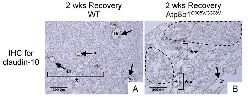 Atp8b1G308V/G308V mice exposed to hyperoxia and returned subsequently to normoxia for recovery show impaired bronchiolar regeneration. WT and Atp8b1G308V/G308V mice at 7-9 weeks of age were exposed to room air or 100% O2 for 48 hours, and then allowed to recover under normoxia for 12 days (n=3 for each). Representative photomicrographs of lung sections immunohistochemically labeled for claudin-10 are shown. Arrows denote relatively intact bronchiolar lumens. (A) WT lungs recovered from hyperoxia display normal regeneration of bronchioalveolar structures wherein organized arrangements of bronchioles surrounded by intact alveoli are noted (area designated by one asterisk). (B) Atp8b1G308V/G308V lungs recovered from hyperoxia display impaired regeneration of bronchioalveolar structures wherein incomplete bronchiolar structures (two asterisks) are juxtaposed to highly remodeled lesions (areas circled by dashed lines). Br: Bronchiolar lumen. Magnifications: (A and B) 200X. Data presented are representative of two independent experiments.