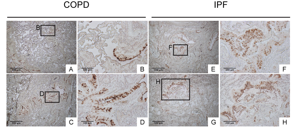 IPF lungs show aberrant CCSP expression at bronchiolar epithelium with hypercellularity. Immunohistochemical staining for CCSP was performed on lung tissue sections from patients with IPF and patients with COPD (control for IPF) (n=4 for each). Labeled boxes correspond to their respective enlarged images. (A, B, C & D) Representative photomicrographs of lung sections from COPD patients display relatively organized arrangement of CCSP expression in apical side of bronchiolar epithelium. (E, F, G & H) Representative photomicrographs of lung sections from IPF patients. Hyperplastic bronchiolar epithelium randomly displays accumulation of cells with varying degrees of CCSP expression. Magnifications: (A, C, E, G) 40X; (H) 100x; (B, D, F) 200X. Data presented are representative of one experiments.