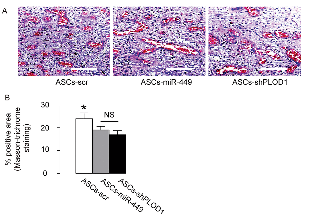 Transplantation of either ASCs-miR-449 or ASCs-shPLOD1 reduces levels of fibrosis than ASCs during facial nerve regeneration in rats. (A-B) The effects of transplantation of ASCs-miR-449, ASCs-shPLOD1 and control ASCs-scr on the fibrosis were evaluated by Masson-trichrome staining 8 weeks after the surgery in rats, shown by representative images (A), and quantification (B). *p