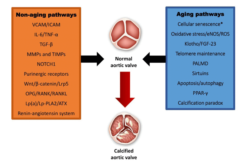 Aortic stenosis: what is the role of aging processes? | Aging