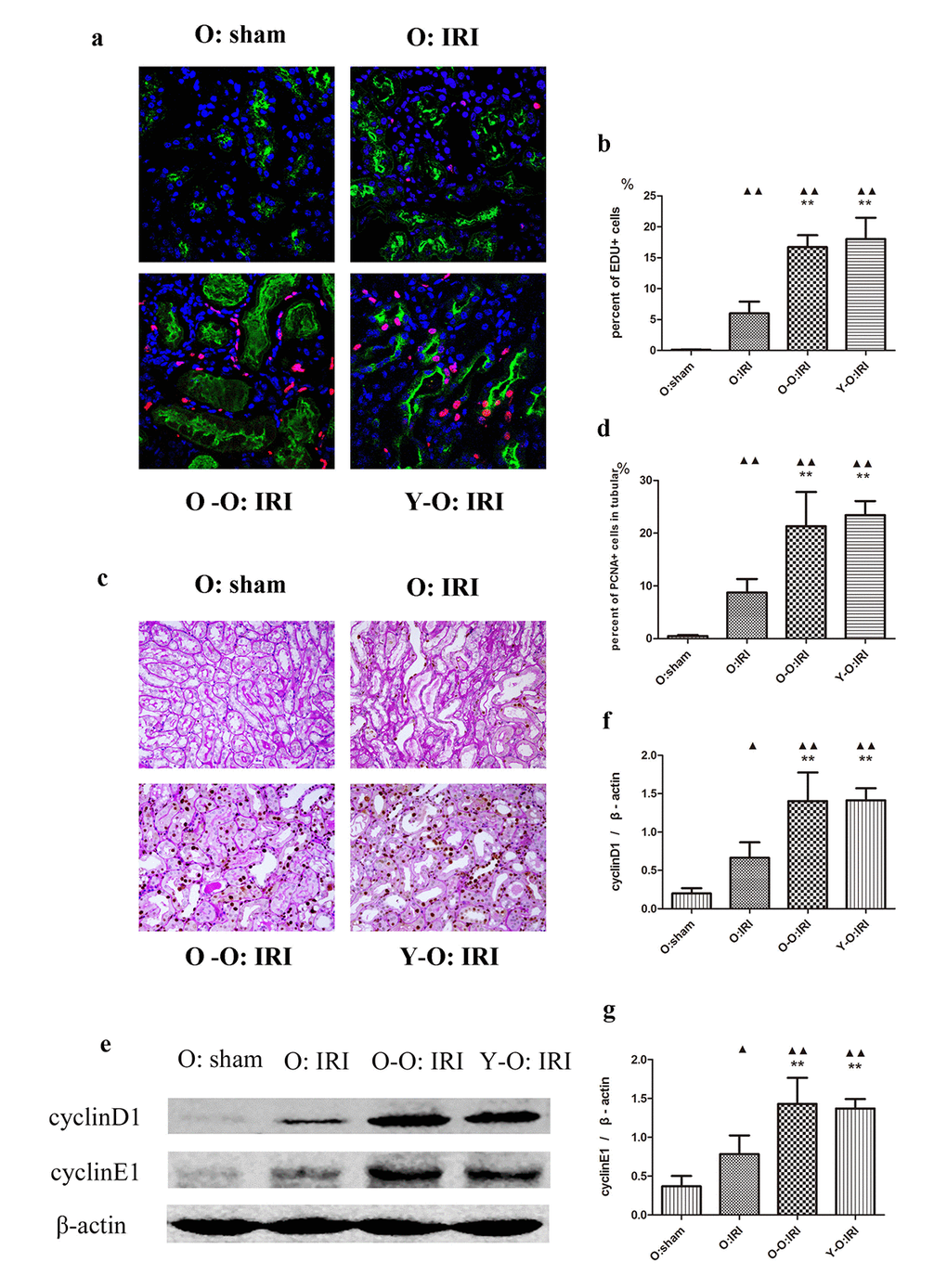 Exogenous biological renal support increased renal cell proliferation in old IRI mice. (A) Representative images of renal EdU-positive cells in independent groups (600× magnification; red, EDU; green, LTL; blue, DAPI). (B) The percentages of EdU-positive cells in the kidneys of the old mice at 72 hours after IRI. The mice in the O: IRI group displayed more EdU-positive cells than in O: sham group. The percentage of EdU-positive cells was higher in the O-O: IRI group and the Y-O: IRI group than in the O: IRI group. No significant difference was found between the O-O: IRI group and the Y-O: IRI group. (C) Representative images of renal PCNA-positive tubular cells in independent groups (400× magnification). (D) The percentages of PCNA-positive tubular cells in the kidneys of the old mice at 72 hours after IRI. The mice in the O: IRI group had more PCNA-positive tubular cells than the O: sham group. The percentages of PCNA-positive tubular cells were higher in the O-O: IRI group and the Y-O: IRI group than in the O: IRI group. No significant difference was found between the O-O: IRI group and the Y-O: IRI group. (E) The levels of cyclin D1 and cyclin E1 in kidney extracts of the old IRI mice as measured by western blotting. Gels were performed under the same experimental conditions. (F, G) Quantitative analyses of the band densities of cyclin D1 and cyclin E1 protein expression. Data are presented as means ± SDs. ▲P P 