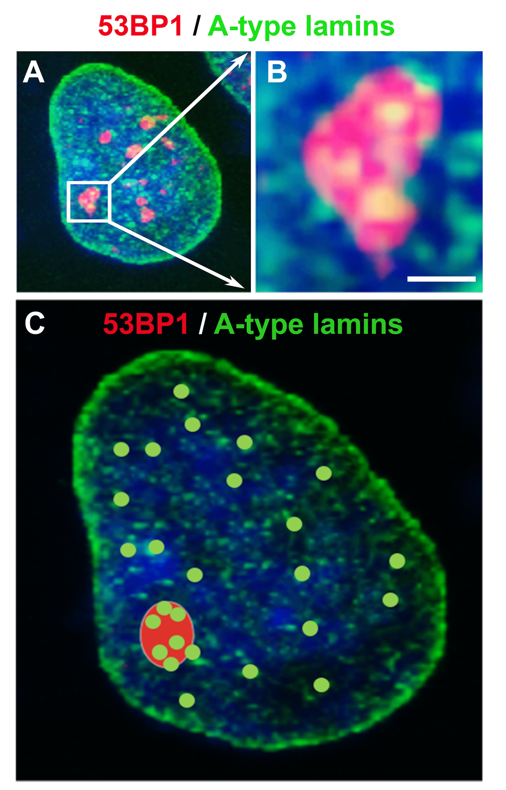 The nuclear distribution pattern of A-type lamins (green) in 53BP1-positive DNA repair foci (red). (A) Spontaneously occurring DNA lesions in HeLa cells are shown, and (B) magnification is delineated by white arrows. Although A-type lamins do not directly accumulate at DNA lesions, (C) lamin A/C positivity in spontaneous DNA lesions could be essential for the stability of these 53BP1-positive foci and their error-free repair (refer to primary data and methodology in [155,156]). Scale bars, 0.5 µm.