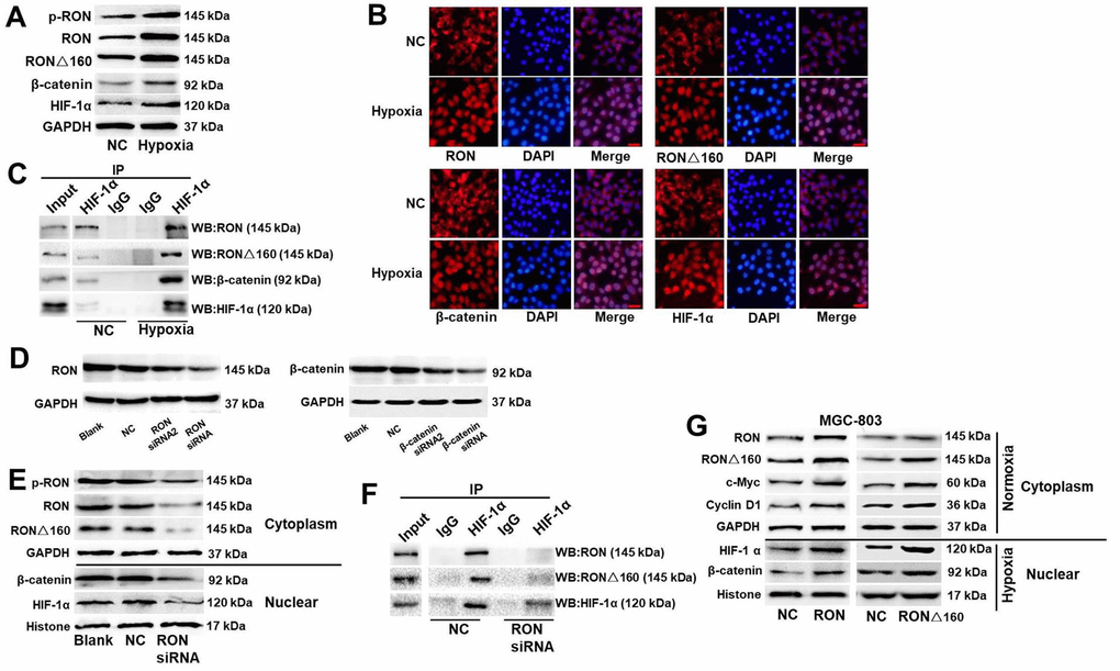 Effect of hypoxia on HIF-1α binding to the RON/RONΔ160-β-catenin complex. (A) Western blots of p-RON, RON, RONΔ160, β-catenin, and HIF-1α in KATOIII cells under normoxic and hypoxic conditions. (B) Immunostaining showing nuclear localization of RON, RONΔ160, β-catenin, and HIF‑1α in KATOIII cells under normoxic and hypoxic conditions. Scale bar = 50 μm. (C) Interaction between HIF-1α and the RON/RONΔ160-β-catenin complex in KATOIII cells under normoxic and hypoxic conditions. (D) Western blots showing suppression of RON and β-catenin in KATOIII cells transfected with siRNAs targeting RON or β-catenin. (E) and (F) Western blots (E) and co-immunoprecipitation assays (F) showing the suppressive effect of RON siRNA the interaction between HIF-1α and the RON/RONΔ160‑β-catenin complex. (G) Western blots showing levels of RON, RONΔ160, β‑catenin, and HIF-1α in MGC-803 cells overexpressing RON of RONΔ160. Scale bar = 50 μm in all panels.
