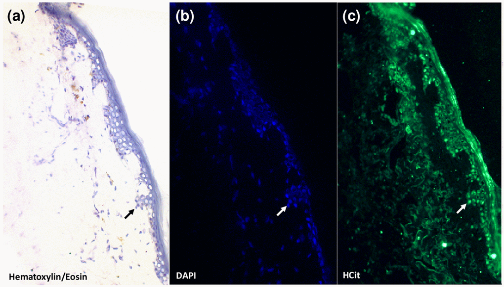Evidence for the presence of carbamylated proteins inside human skin cells. An anti-HCit immunolabelling was realized in a skin section from a 77-year old man counter-stained with DAPI and hematoxylin-eosin. Epidermal area was screened by light microscopy thanks to hematoxylin-eosin counterstaining (a). Nuclei were highlighted by DAPI staining (b, blue) permitting confirmation of the presence of HCit inside skin cells by immunofluorescence analysis (c, green). An example of a cell exhibiting a positive intracellular labelling for HCit is indicated by arrows. Observations were realized at 10x magnification.