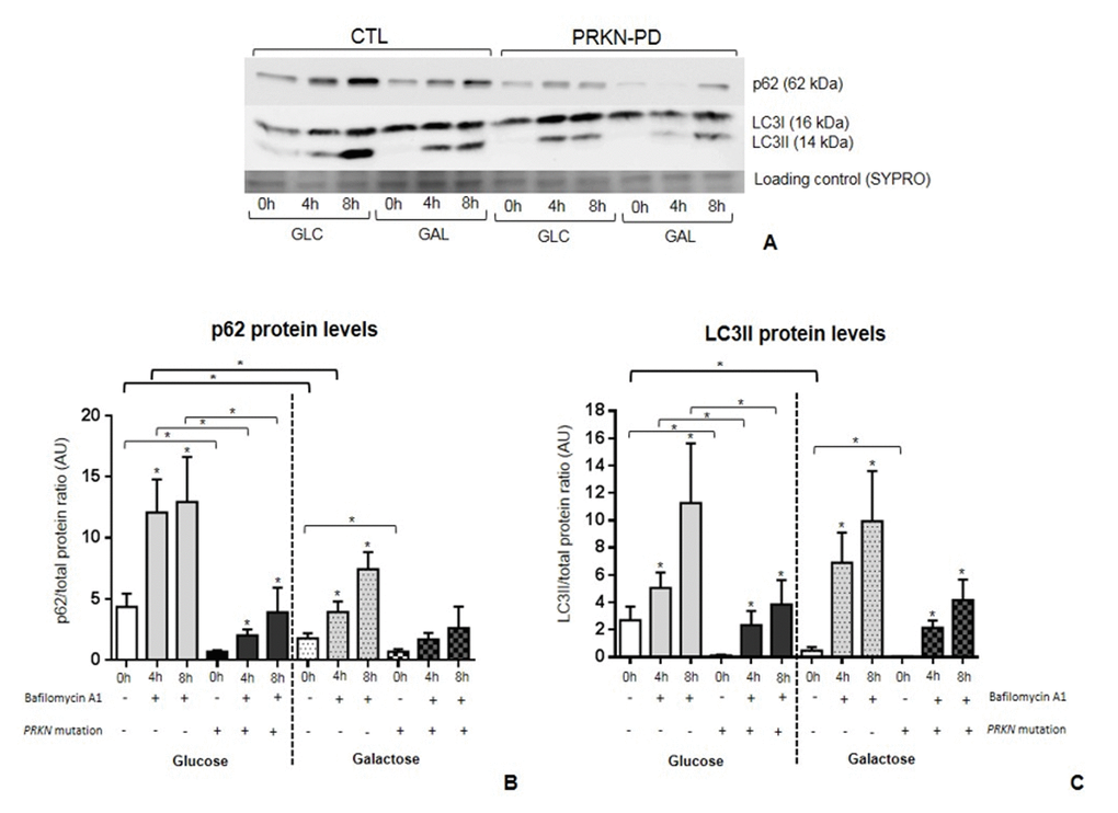Autophagic flux incontrol and PRKN-PD fibroblasts. p62 (A) and LC3BII (B) protein levels at basal (0h) and under bafilomycin A1 treatment (4 or 8h) in glucose and galactose media. Basal levels p62 and LC3BII were significantly decreased in PRKN-PD compared to control fibroblasts in both media. PRKN-PD fibroblasts presented significantly lower p62 and LC3BII levels after 4 and 8 hours of treatment compared to controls in glucose and the same tendency was obtained in galactose. Exposure to galactose significantly decreased basal levels of both molecules compared to glucose in controls, but not in PRKN-PD fibroblasts. Controls, but not PRKN-PD, also showed significantly reduced p62 in front of conserved LC3BII protein levels upon treatment. Asterisks above the bars indicate statistically significant differences between protein levels at basal (0h) and after of bafilomycin A1 treatment (4 or 8h) within a group. The results are expressed as means and standard error of the mean (SEM). Asterisk brackets indicate statistically significant differences between CTL and PRKN-PD fibroblasts. Bold asterisk brackets indicate statistically significant differences between media. GAL= 10 mM galactose medium. GLC= 25 mM glucose medium. PRKN-PD= Parkin-associated PD fibroblasts.