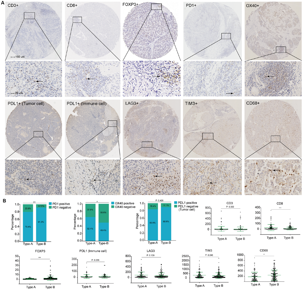 (A) Representative immunohistochemistry images of the ten immune markers. The bars (150 μm and 20 μm) were shown in the upper left figures. (B) Associations of stromal type with the immune markers. According to the data distributions, the optimal cut-off values for OX40 and PD1 were selected to perform comparison between groups, positive PD-L1 tumor cells staining was defined as more than 1% tumors cells staining on the membrane of the tumor cells. The others were compared by continuous data.