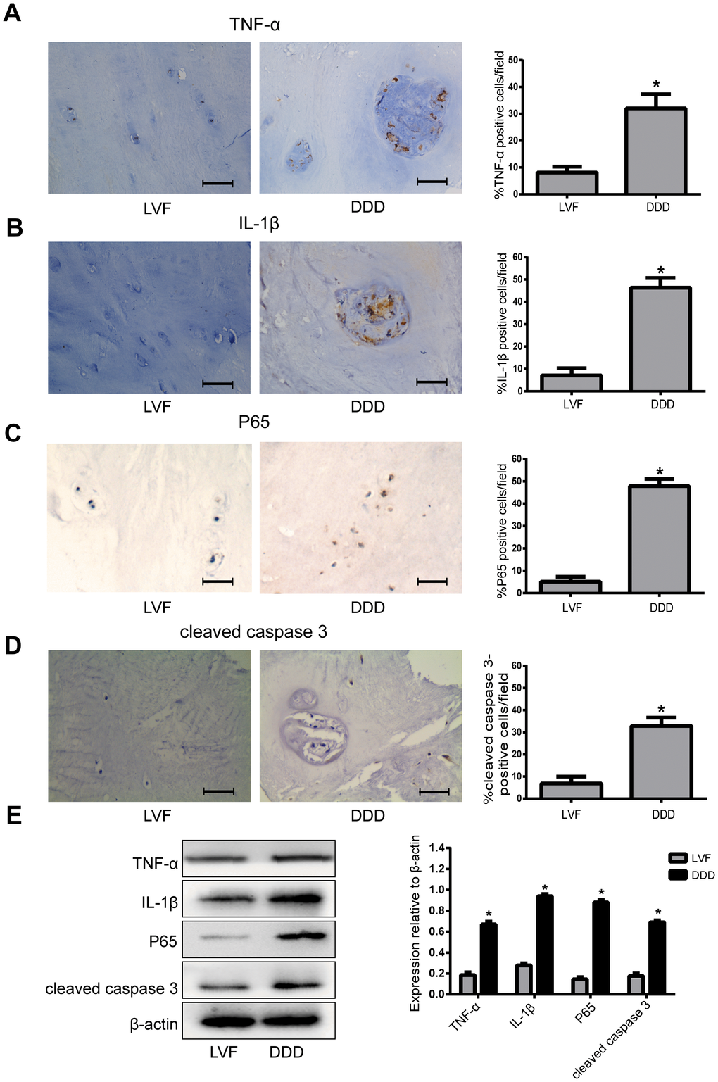 The expression of TNF-α, IL-1β, P65 and cleaved caspase 3 in human NP tissues from LVF and DDD group. (A), (B), (C) and (D) Immunohistochemistry results show that the levels of TNF-α (A), IL-1β (B), P65 (C) and cleaved caspase-3 (D) were significantly increased in NP tissues from patients with DDD (magnification ×400); (E) Western blot for the protein level of TNF-α, IL-1β, P65 and cleaved caspase 3. Values are means ±SEM.*p