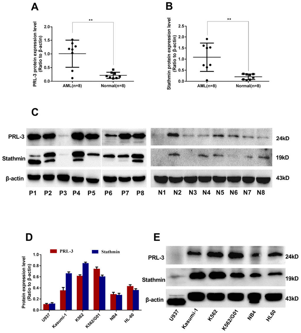 Expression of PRL-3 and stathmin in clinical samples and cell lines detected by western blot. (A–C) Expression of PRL-3 and stathmin in de novo myeloid leukemia patients. (D, E) Expression of PRL-3 and stathmin in myeloid leukemia cell lines. (*PPvs. healthy normal control). Note: N, healthy normal control. P, de novo patient.