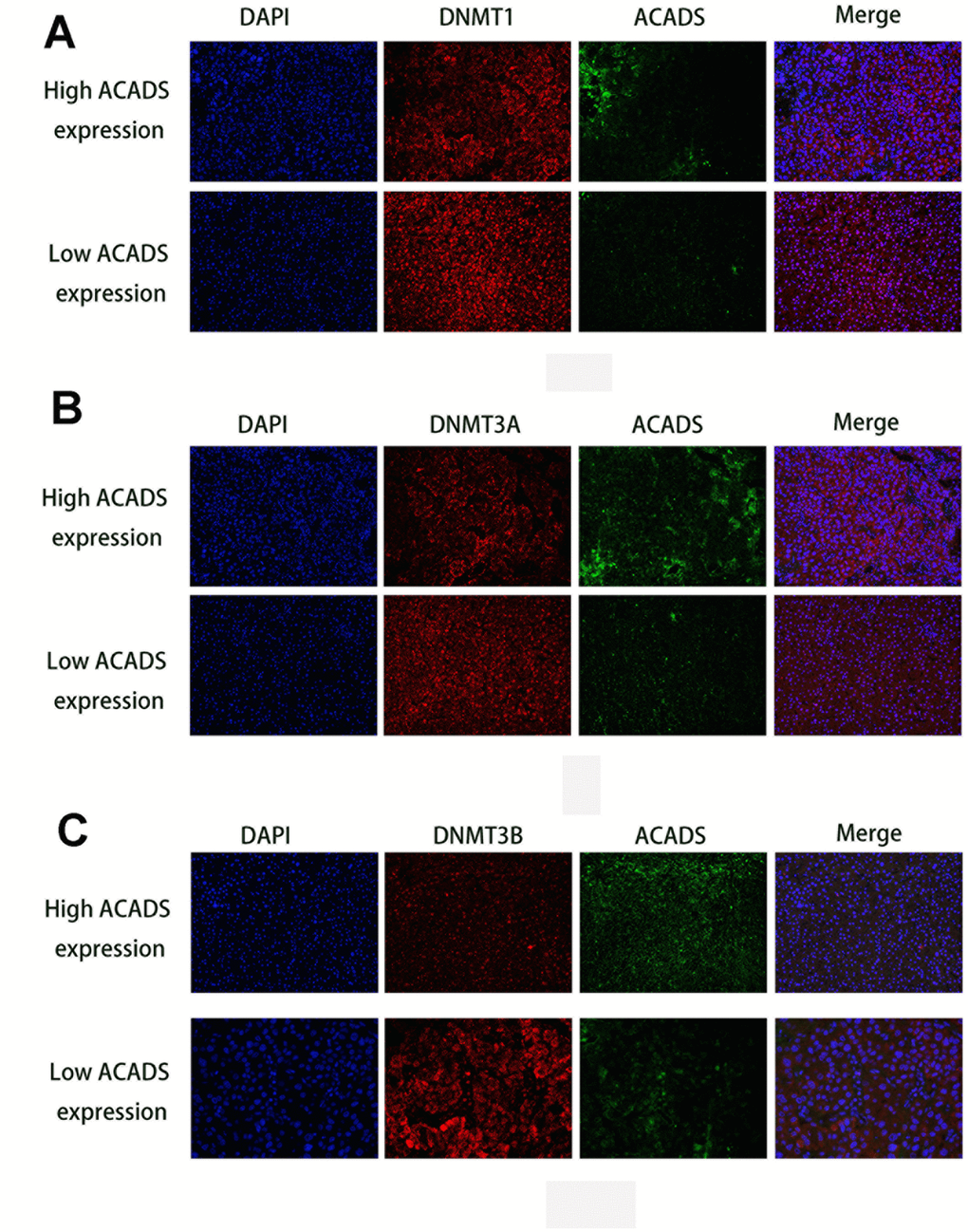 Immunofluorescence staining results of DNMTs and ACADS in HCC microarrays. (A) Immunofluorescence staining of DNMT1 (red) and ACADS (green) in high and low ACADS groups. (B) Immunofluorescence staining of DNMT3A (red) and ACADS (green) in high and low ACADS groups. (C) Immunofluorescence staining of DNMT3B (red) and ACADS (green) in high and low ACADS groups.
