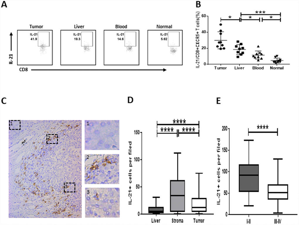 Strong infiltration of IL-21-producing CD8+CXCR5+ T cells in HCC correlates with disease stage. (A–B) Flow cytometric analysis of IL-21 production by CD8+CXCR5+ T cells (n=9). The cells were characterized using FACS with sequential gating of lymphocyte cells, CD45+ cells and then CD8+CXCR5+ cells. (A) One representative experiment is shown. (B) The data indicate the median with the interquartile range. (C–E) Immunohistochemical staining of IL-21+ cells in paraffin-embedded HCC tissue (n=96). The distribution of IL-21+ cells is shown in (C and D). Micrographs at higher magnification show the stained peritumoral liver (1), peritumoral stromal region (2), and cancer nest (3). The association of the density of tumor-infiltrating IL-21+ cells with the TNM staging of patients is shown in (E). *PPP****P0.0001 determined using Mann-Whitney U test (B and D) or student’s t test (E).