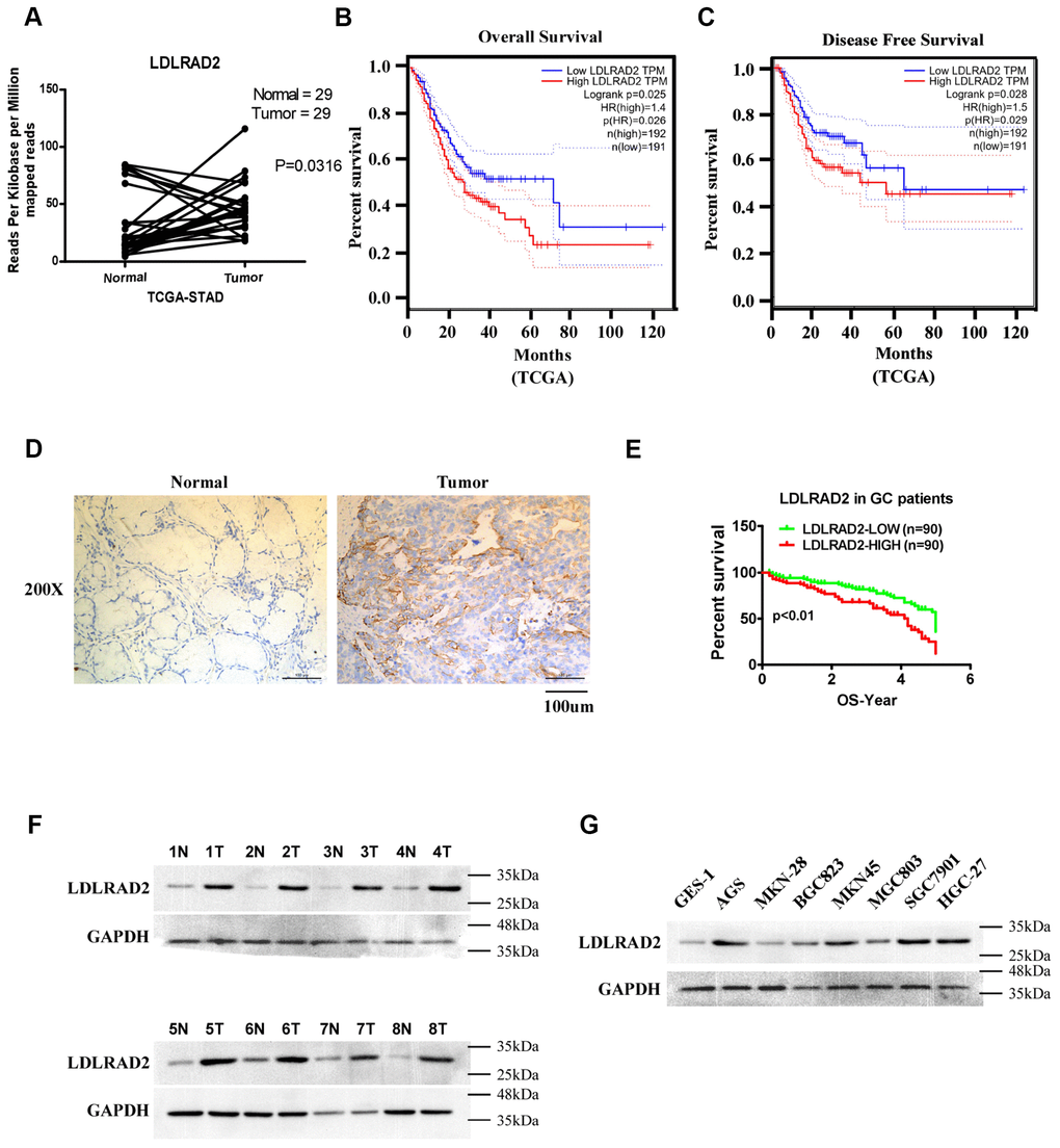 High LDLRAD2 expression correlates with poor prognosis and unfavorable clinical features in GC patients. Bioinformatics analysis showed that LDLRAD2 mRNA expression was significantly higher in GC samples compared with normal samples (A). High LDLRAD2 expression was closely correlated with short overall survival (B) and disease-free survival (C). Immunohistochemical staining showed that LDLRAD2 expression was higher in GC samples than normal control (D). Kaplan-Meier survival analysis of 180 patients from our clinical center suggested that patients with high LDLRAD2 expression had a decreased overall survival (E). Western blotting analysis further confirmed that LDLRAD2 expression is upregulated in human GC (F) and GC cell lines (G). Three independent experiments were performed. *p 