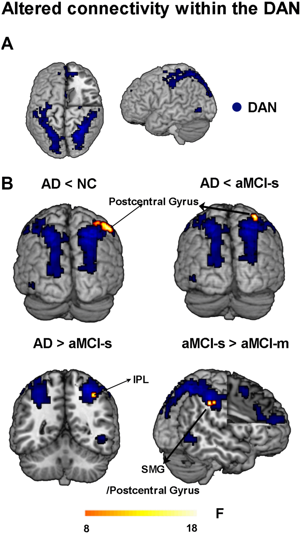 Altered functional connectivity within the DAN among the four groups. (A) Spatial distribution of the DAN (FWE correction). (B) Regions showing altered functional connectivity between different groups. Abbreviations: DAN: dorsal attention network; IPL: inferior parietal lobule; SMG: supramarginal gyrus; AD: Alzheimer's disease; aMCI-s: single-domain of amnestic mild cognitive impairment; aMCI-m: multiple-domain of amnestic mild cognitive impairment; NC: normal controls.