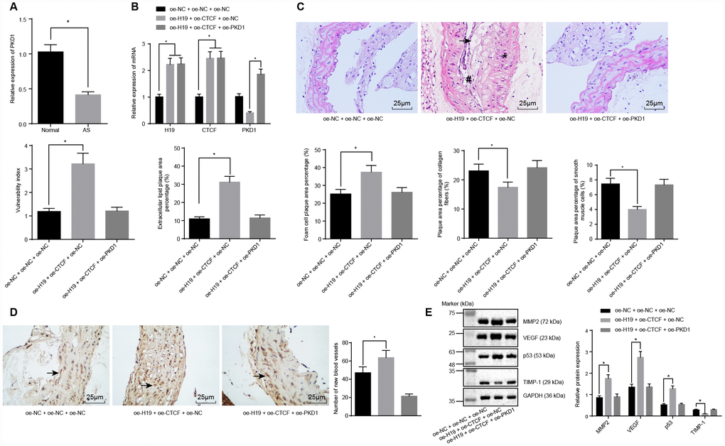 H19 is involved in atherosclerotic vulnerable plaque formation and intraplaque angiogenesis through down-regulating PKD1 by recruiting CTCF in ApoE knockout mice with AS. (A) The expression pattern of PKD1 in the aortic tissues of normal and AS mice determined by RT-qPCR. * p vs. the control group. (B) The overexpressing efficiency of H19, CTCF and PKD1 assessed by RT-qPCR. * p vs. the oe-NC + oe-NC + oe-NC group; # p vs. the oe-H19 + oe-CTCF + oe-NC group. (C) The atherosclerotic vulnerable plaque formation evaluated by HE staining (× 400) (The arrow referred to lipid vacuoles, * represented inflammatory cells and # indicated fractured smooth muscle). (D) The number of new blood vessels measured by Immunohistochemical staining (× 400) (The arrow referred to CD34-positive cells). (E) The protein levels of MMP-2, VEGF, p53 and TIMP-1 in atherosclerotic plaques normalized to GAPDH after transfection determined by Western blot analysis. * p vs. the oe-NC + oe-NC + oe-NC group. The data were measurement data and expressed by mean ± standard deviation. Data differences between two groups were analyzed by unpaired t-test; comparisons made among multiple groups were analyzed by one-way ANOVA. The experiments were repeated three times independently.