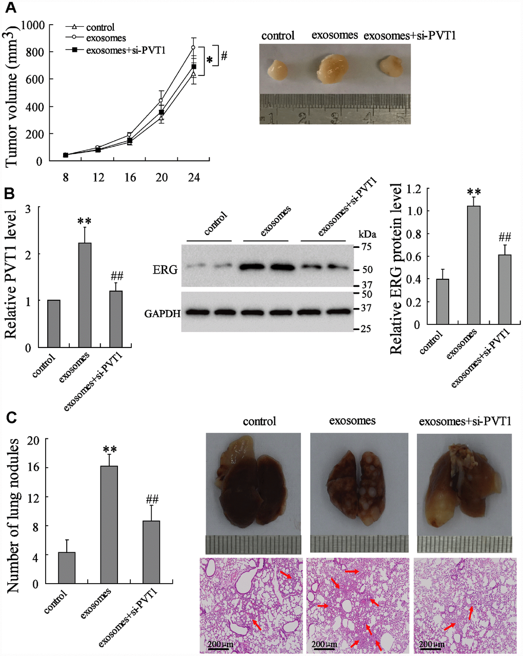 PVT1 in BMSC-EXO promotes osteosarcoma growth and metastasis via increasing ERG in vivo. The mouse xenograft (n=18) was established by subcutaneous inoculation of MNNG/HOS cells, and the pulmonary metastatic model (n=18) was established by tail vein injection of MNNG/HOS cells. Eight days after the establishment of xenograft and 3 weeks after the establishment of metastatic model, mice were divided into 3 groups, the control group (with PBS injection in tail vein, n=6), the exosome group (with 10 μg of BMSC-EXO injection in tail vein, n=6), and the exosomes+si-PVT1 group (with PVT1-interfering BMSC derived exosome injection in tail vein, n=6). (A) The tumor volume was detected every 4 days. (B) The expression of PVT1 and ERG in tumor tissues after 3 weeks. (C) The number and the H&E staining of lung metastatic nodules (red arrows). *p