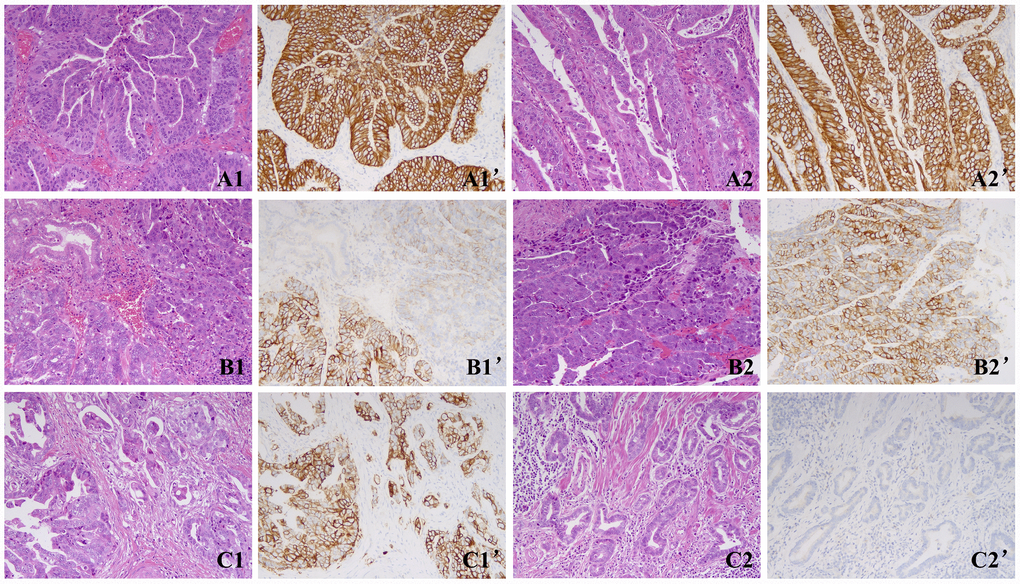 Representative images of the two cohorts. (A) A case of cohort A showed concordant HER2 results between the two blocks with homogeneous HER2 3+ staining. A1, A1’, Block 1; A2, A2’, Block 2. (B) A case of cohort A showed concordant HER2 results between the two blocks with heterogeneous HER2 3+ staining. B1, B1’, Block 1; B2, B2’, Block 2. (C) A case of cohort B showed discordant HER2 results between both blocks with 3+ in block 1 and 0 in block 2. C1, C1’, Block 1; C2, C2’, Block 2. Magnification ×200.